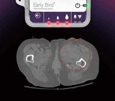 Clinical Performance of the Early Bird Bleed Detection Device
