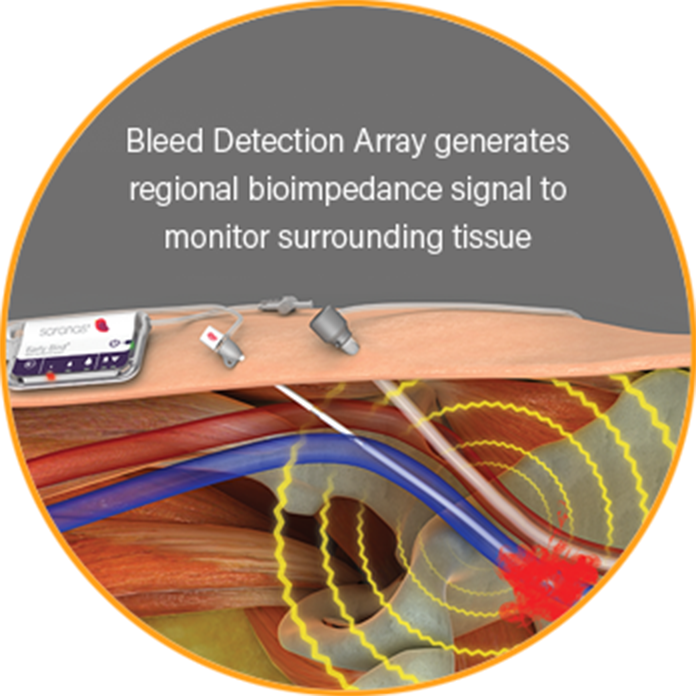 Bleed Monitoring Device for Endovascular Procedures